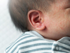 Newborn rash